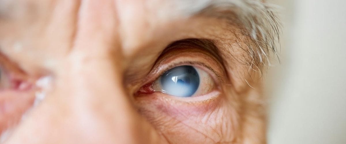 Cataracta: cauze, simptome și tratament eficient înainte de afectarea ireversibilă